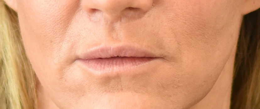 Lip Lift Patient 8 Set 1 After